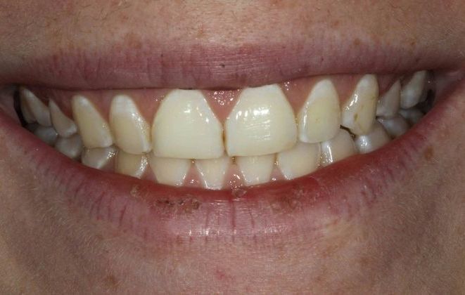 before veneer treatment