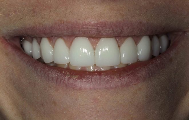 after veneers treatment